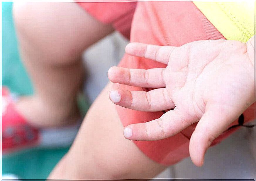 Blisters in children: hand with blisters on the fingertips