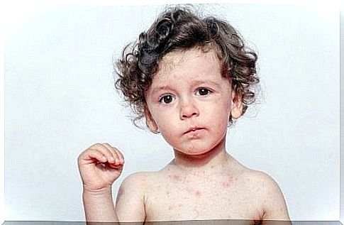 Sweat allergy in children: symptoms and treatment