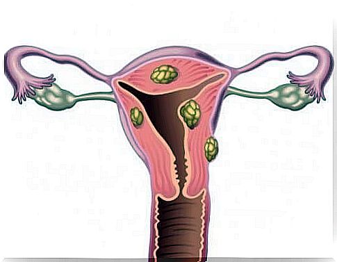 Uterine fibroids and infertility